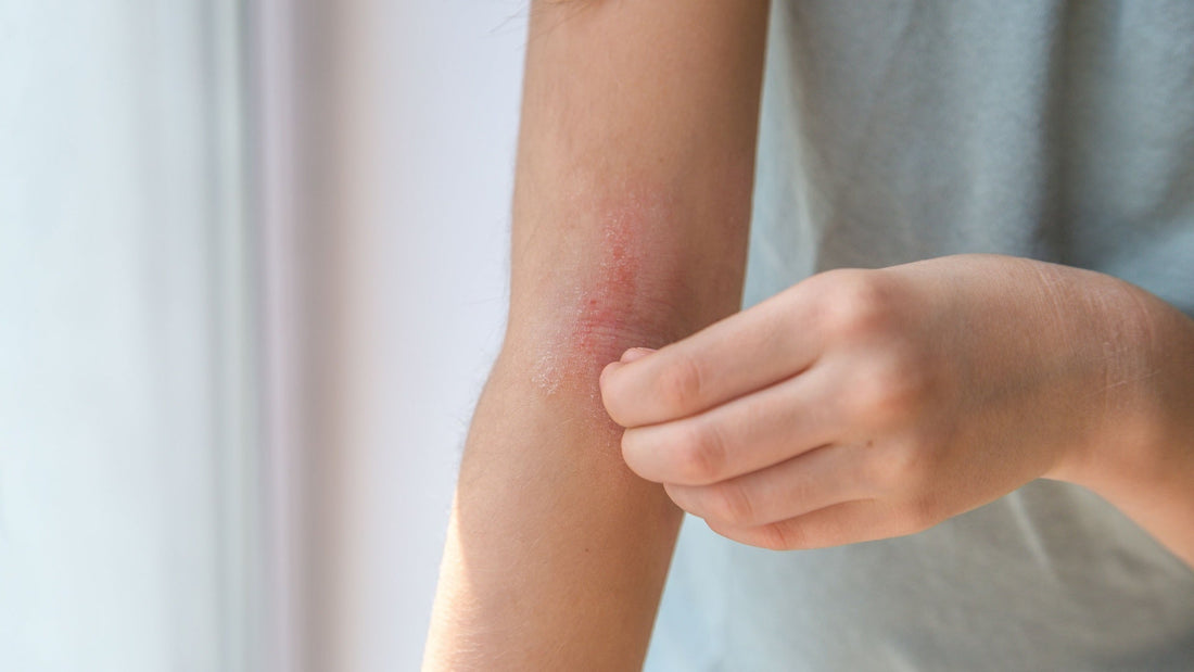 Probiotics help relieve eczema